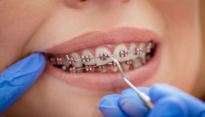 How-to-stop-braces-pain-immediately